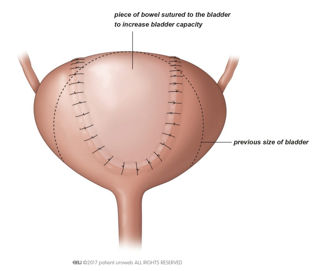 Bladder augmentation surgery